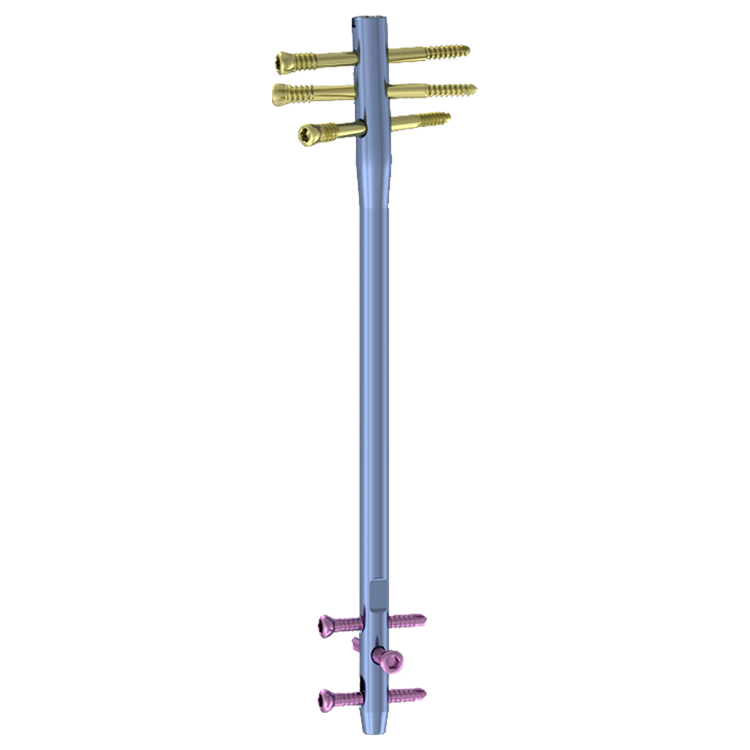 Femoral reverse interlocking nail